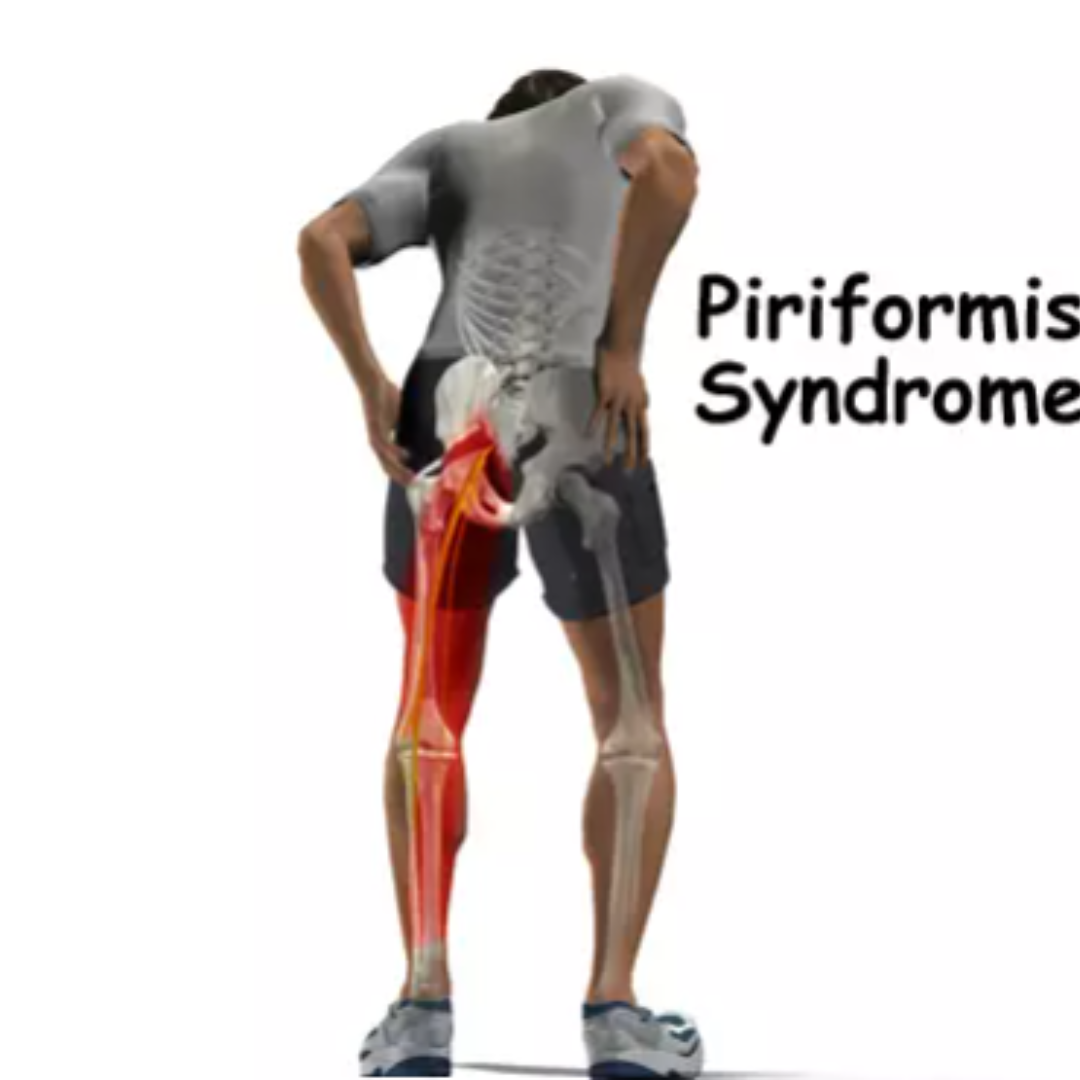 Piriformis Syndrome Relief: Aspire Clinic Insights